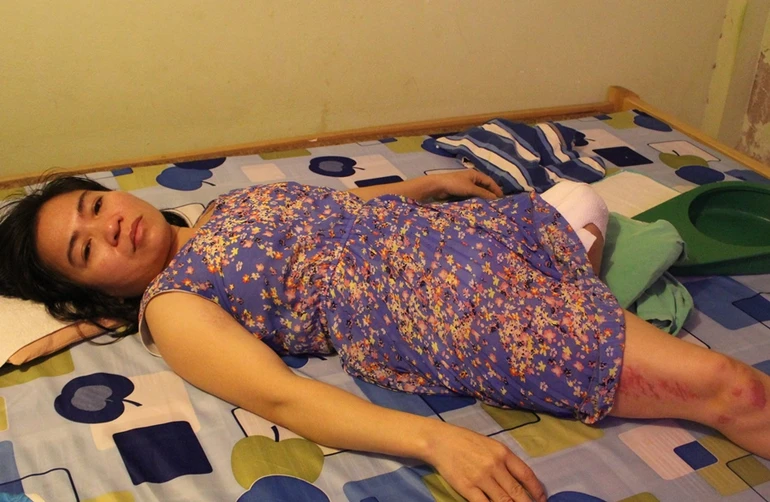 Giúp chị Bình làm chân giả